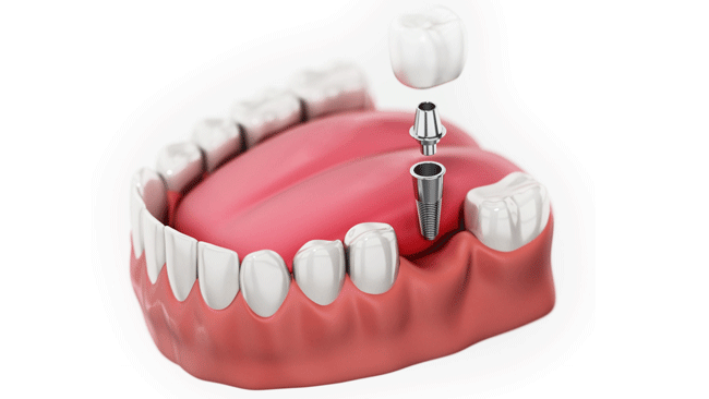 Implantologie Implantologie